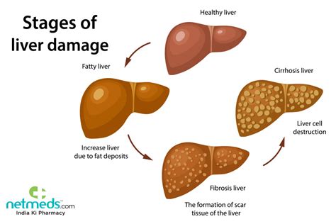 Cirrhosis of the Liver: Symptoms, Stages & Treatment